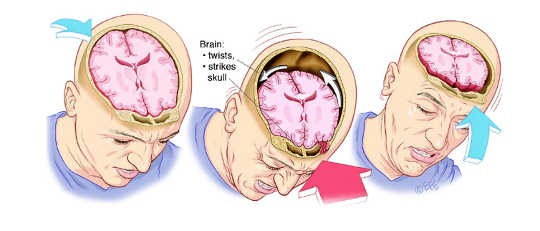 Artist’s sketch of a concussion. Levent Efe for QBI, Author provided