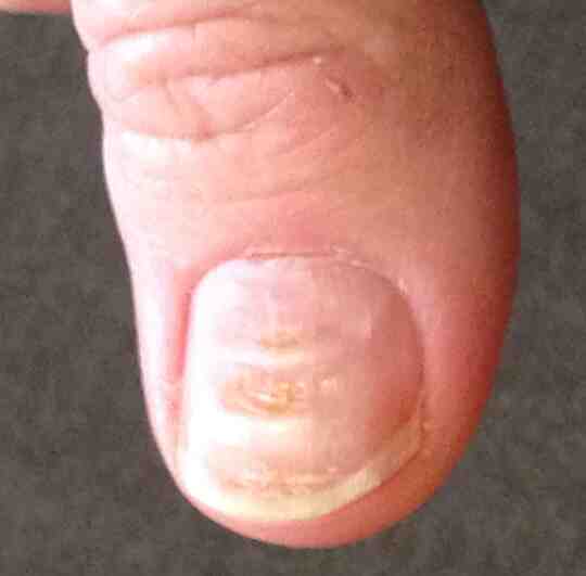 A thumb with Beau's lines