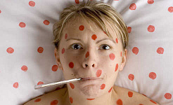 Everything You Need To Know About Chickenpox